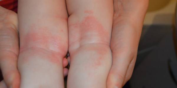 Сыпь и пятна на локтях — как отличить аллергию?