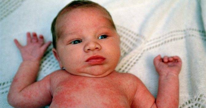 Сыпь по всему телу без температуры у ребенка (41 фото):  причины с пояснениями, красная мелкая сыпь и зуд