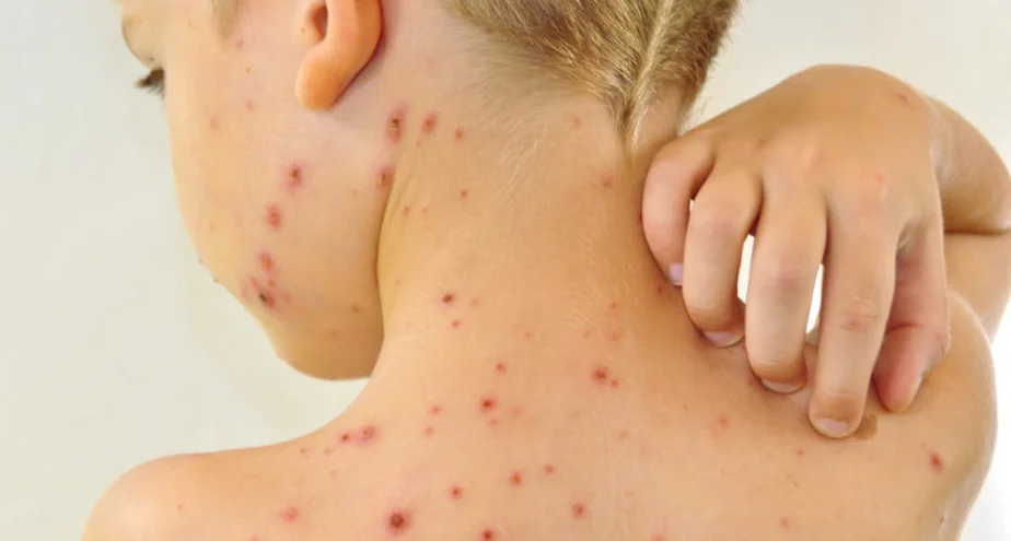 Симптомы и лечение аллергии у детей на лекарства