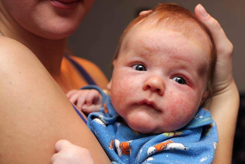 Акне у новорожденных. признаки, как выглядит, фото на лице, голове, груди, спине. как отличить от аллергии, чем лечить, мази, народные средства, уход за кожей ребенка