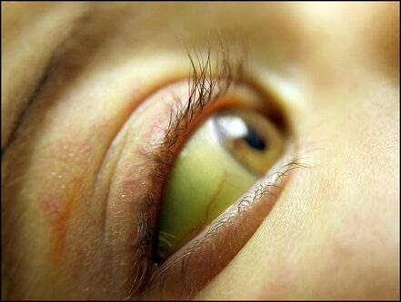 Почему болят глаза у ребенка и что делать родителям?