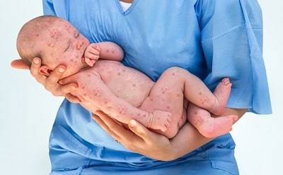 Сепсис новорожденных: причины, симптомы, лечение, последствия, профилактика