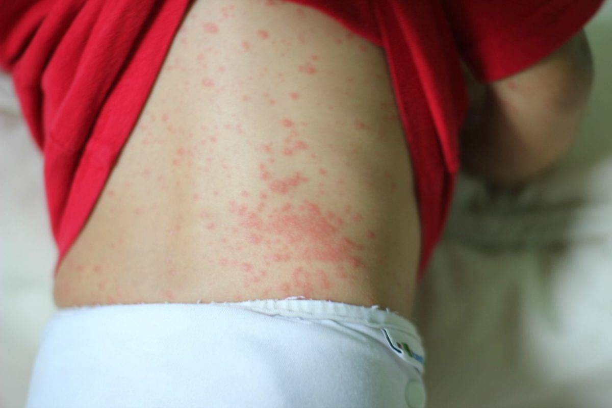 Аллергия на антибиотики у детей: что делать, если у грудничка сыпь после приема