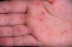 О каких болезнях говорит покраснение и шелушение рук у детей?