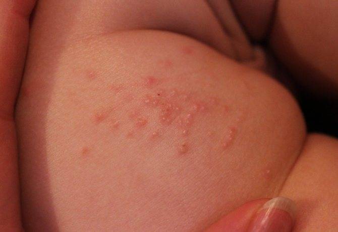 Сыпь на попе у ребенка (27 фото): высыпания с пояснениями, красная и мелкая сыпь на ягодицах и в паху
