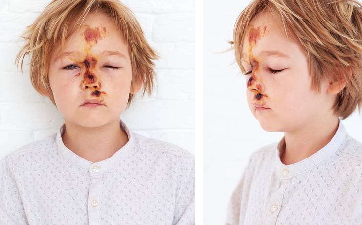 Как остановить кровь из носа у ребенка в домашних условиях?