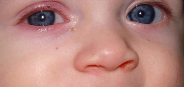 Опух глаз у ребенка. возможные причины