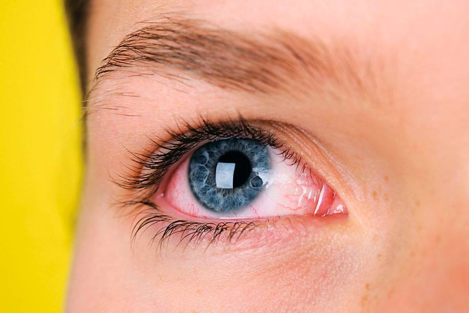 Красные сосуды в глазах у детей: причины покраснения сосудиков на белках у ребенка, лечение грудничка