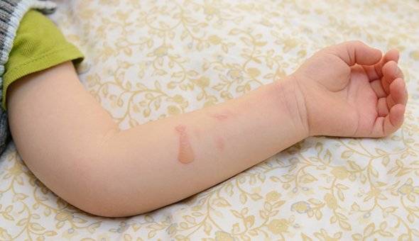 Сыпь у ребенка без температуры: избегаем авантюры