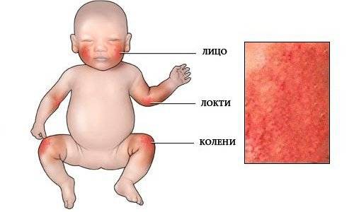 На кошачью шерсть - запись пользователя ирина (irulechek) в сообществе здоровье новорожденных в категории аллергия - babyblog.ru