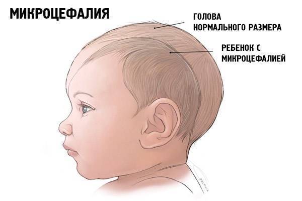 Форма головы у новорожденных: внешний вид новорожденного, голова ребёнка продолговатой формы | метки: вытянутый, фото, вытягивать, исправлять, норма