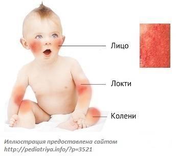 Акне у новорожденных. признаки, как выглядит, фото на лице, голове, груди, спине. как отличить от аллергии, чем лечить, мази, народные средства, уход за кожей ребенка