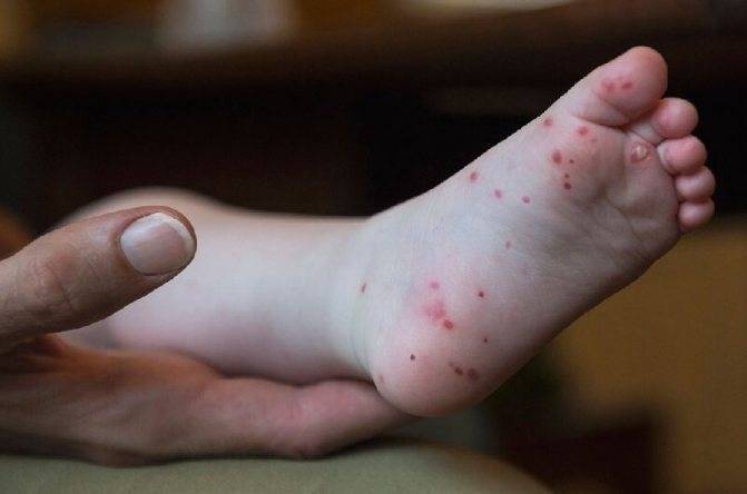 Причины сыпи на коже у новорожденных - виды высыпаний, симптомы и лечение