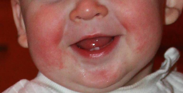 Красные щеки у грудничка — почему краснеют и шелушатся