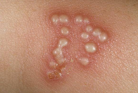 Водянистые пузырьки на коже: фото, причины, лечение