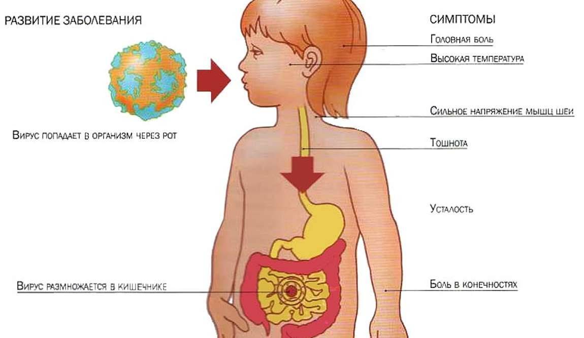Как проявляется ротавирусная инфекция у детей: симптомы и признаки ротавируса, как начинается и течение болезни