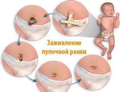 Уход за пупком у новорожденных – на бэби.ру!