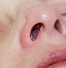 Полипы в носу у ребенка — что это такое, симптомы наростов