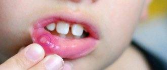 Симптомы и лечение герпеса во рту у ребенка