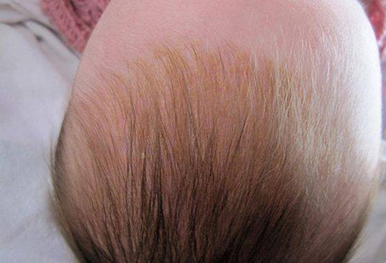 Почему шелушится кожа на голове у грудничка и как помочь малышу