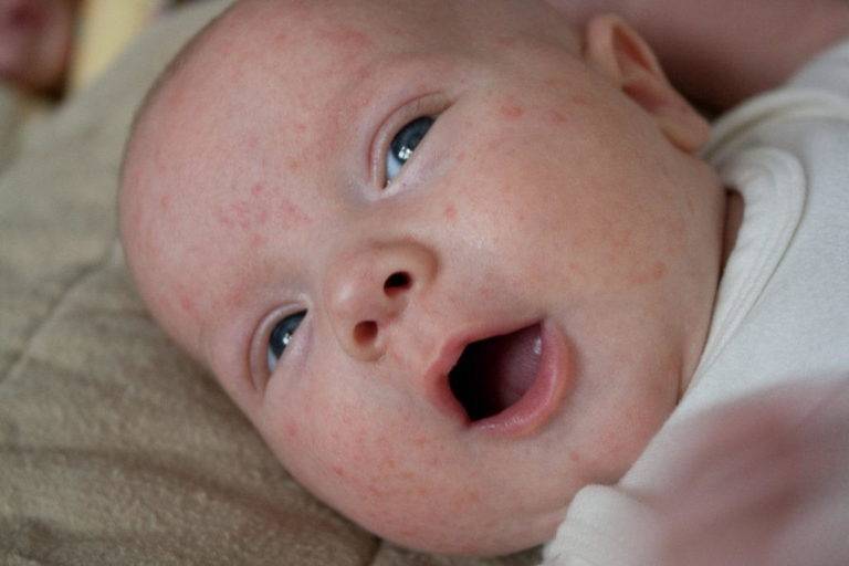 Прыщи на попе у ребенка: причины красных, гнойных белых угрей, что делать, лечение детской присыпкой