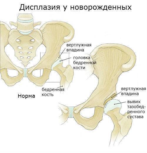 Дисплазия тазобедренного сустава у новорожденных и грудничков