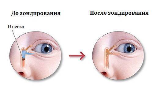 Зондирование слезного канала - запись пользователя анна (anka_tr) в сообществе здоровье новорожденных в категории болезни глаз - babyblog.ru