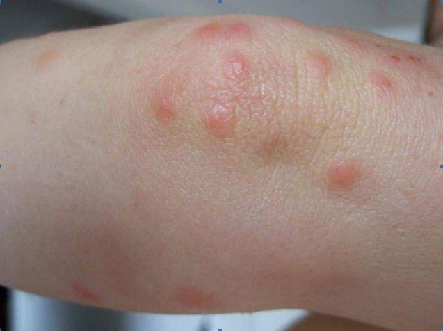 Проявление аллергии в области локтей и коленей