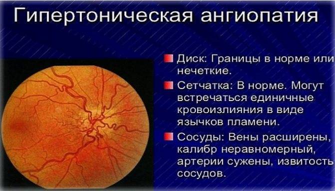Ангиопатия сетчатки глаза у ребенка: что это такое, лечение
