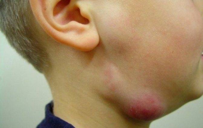 Увеличены лимфоузлы на шее у ребенка — причины воспалений