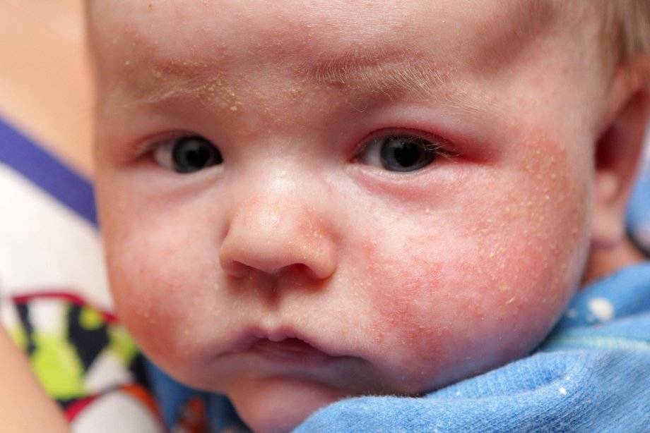 Help: аллергия или акне новорожденных.