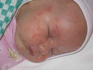 Sorbenty-pri-allergii - запись пользователя яна (sgxcfljd) в сообществе здоровье новорожденных в категории аллергия - babyblog.ru