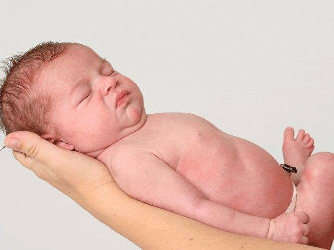 Обработка пупочной ранки у новорожденного – алгоритм действий