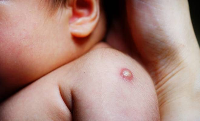 Прививка бцж новорожденному: обязательно ли делать, реакция