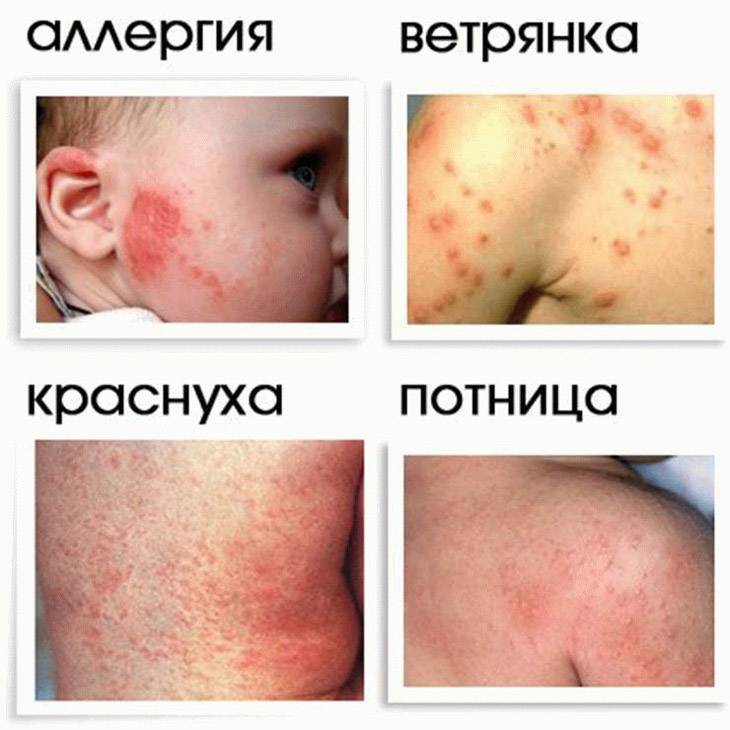 Аллергия у грудничка: лечение, симптомы, профилактика, фото