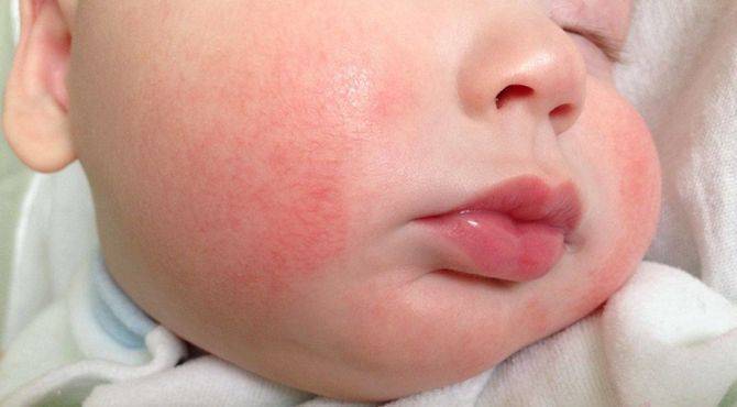 Пищевая аллергия у ребенка