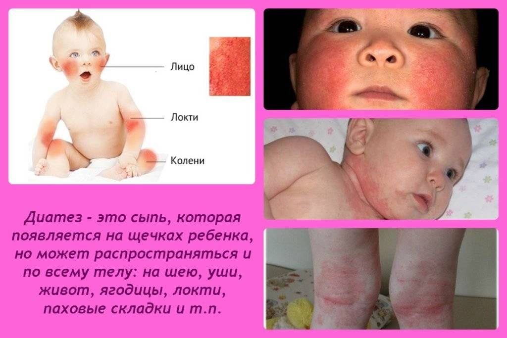 Аллергия на попе у ребенка