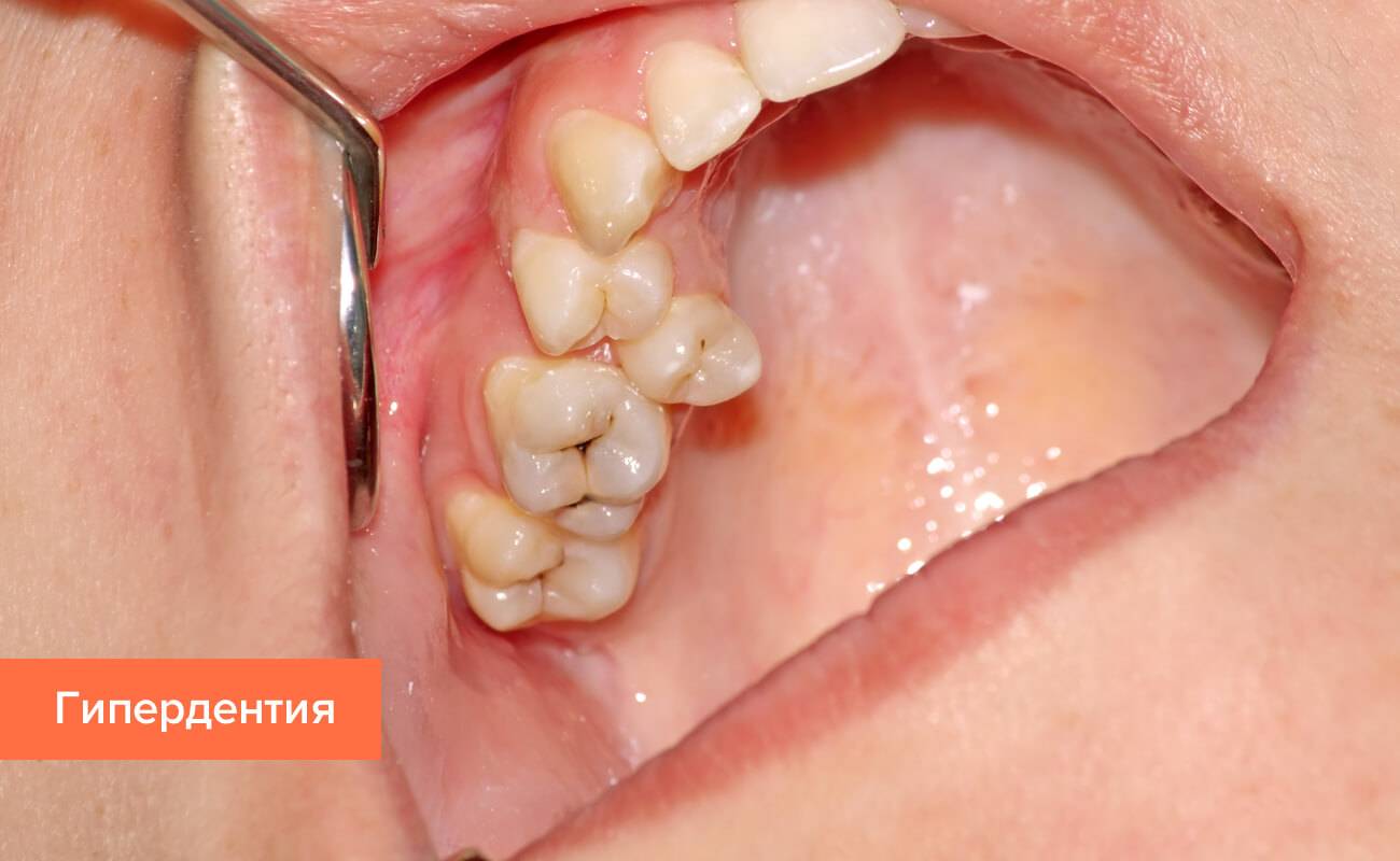 Коренные зубы у детей: сроки и порядок прорезывания, симптомы, чем помочь