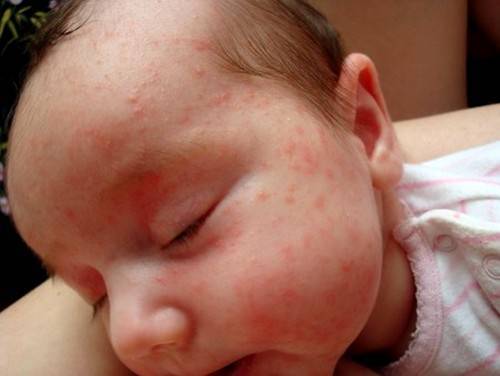 Причины аллергии на лице у грудничка, что делать родителям