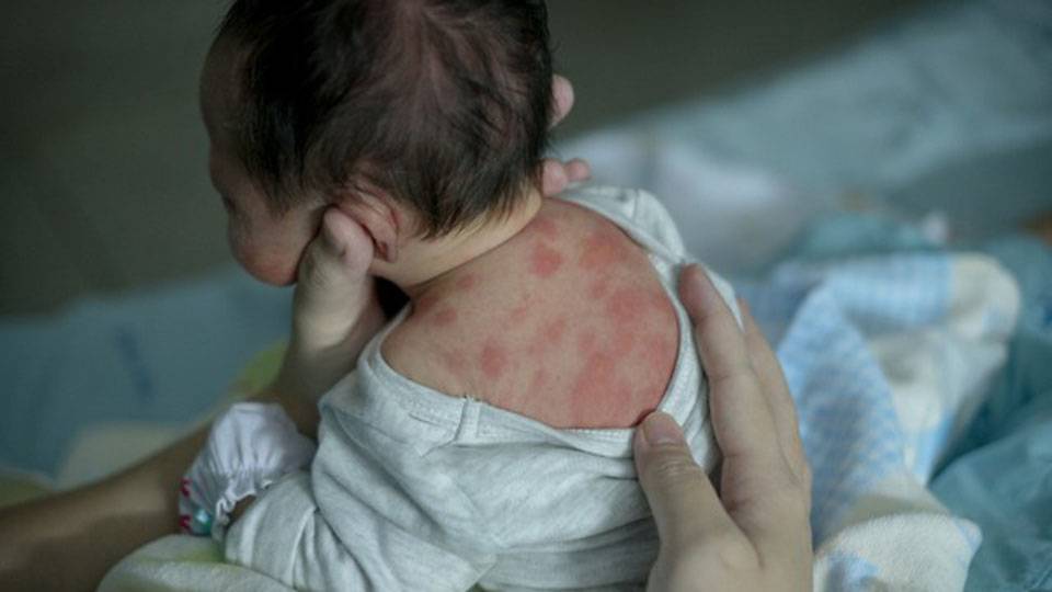 Сыпь на спине у ребенка: фото с пояснениями