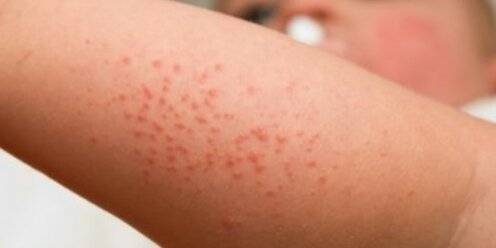 Аллергия на памперсы (24 фото): аллергия на подгузники у девочек и мальчиков, как выглядит и что делать