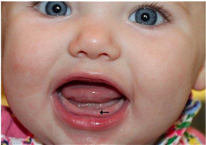 Режутся зубки: как определить симптомы и помочь малышу