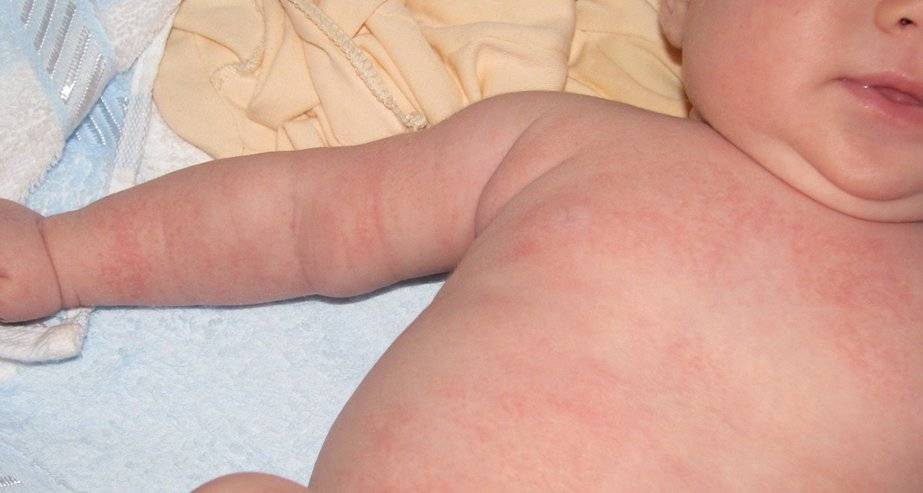 Что делать, если появилась сыпь по всему телу у ребенка, а температуры нет?
