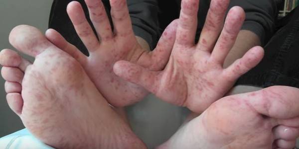 Что необходимо делать, если у ребенка облазит кожа на пальцах ног?