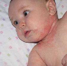 Сыпь после температуры у ребенка — чем помочь грудничку