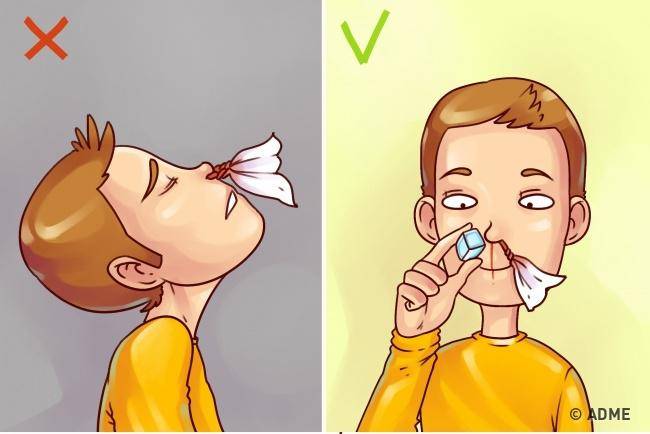 Симптомы, признаки и лечение перелома носа у ребенка