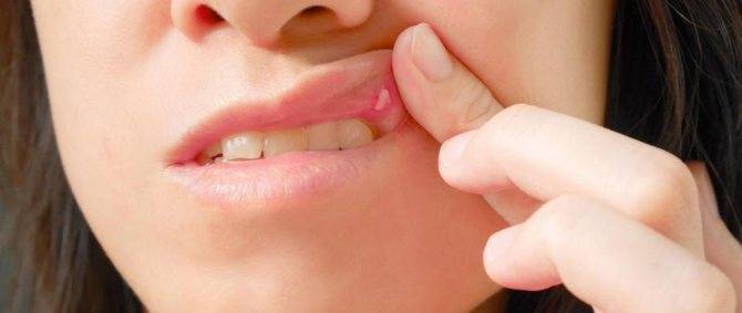 Сыпь вокруг рта у ребенка. причины 2-3, 5-6 лет, чем лечить, что советует комаровский
