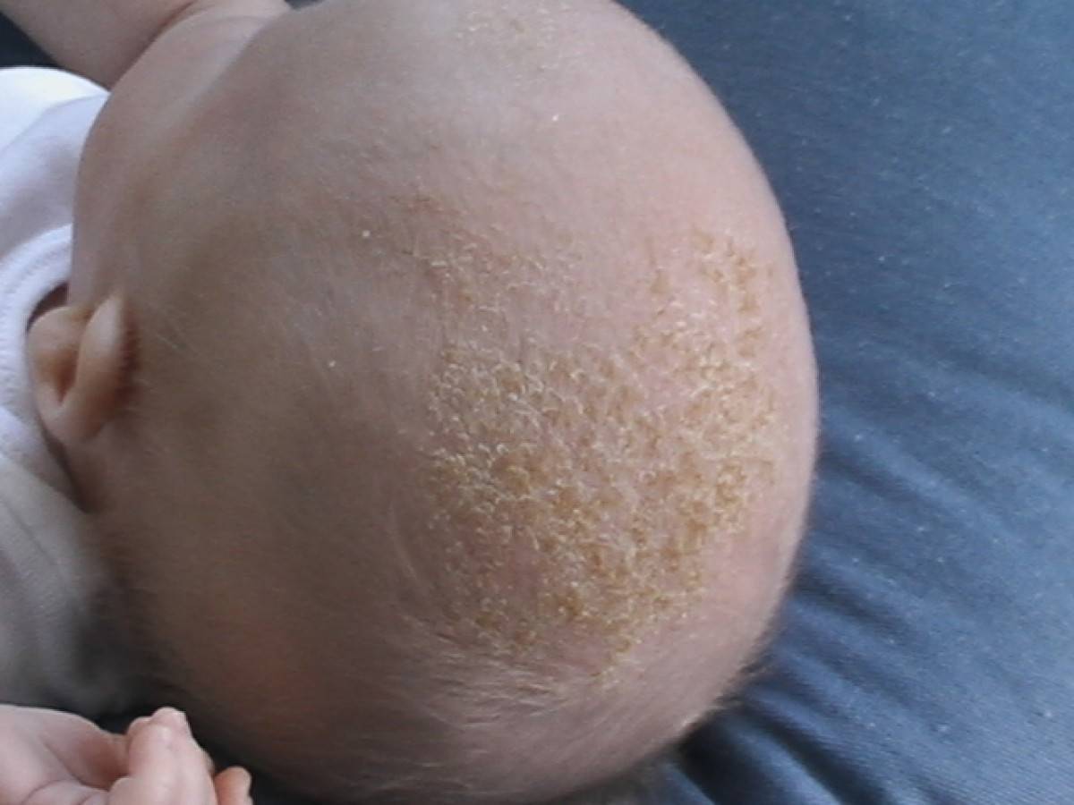 Что делать, если у новорожденного сухая кожа?