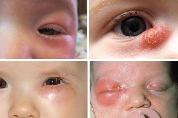 Массаж при дакриоцистите новорожденных: как правильно делать, схема проведения процедуры на глазах, эффект лечения