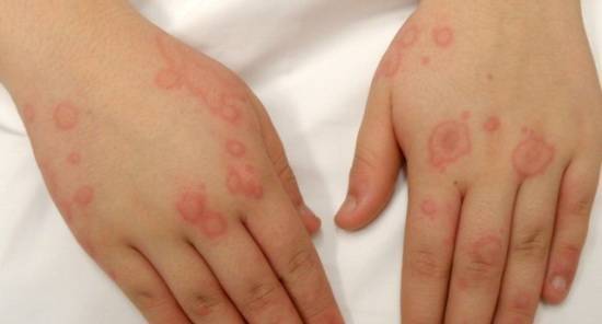 Аллергия на памперсы (подгузники) – фото у девочек, мальчиков, симптомы, лечение